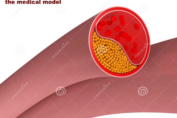 600-cholesterol-ldl-1